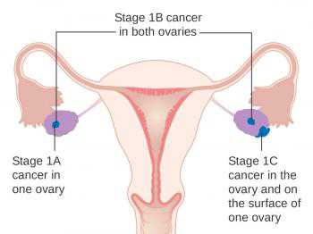 Weight loss surgery may prevent womb cancer