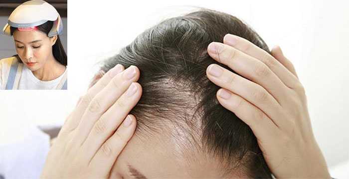 More Women Buy Hair-Loss Products