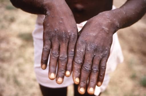 No concern yet monkeypox will cause pandemic: WHO