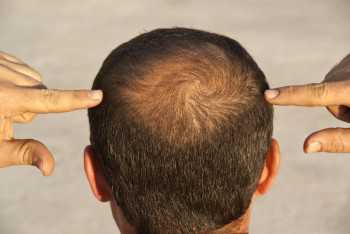 Hair loss: Scientists test wearable regrowth device