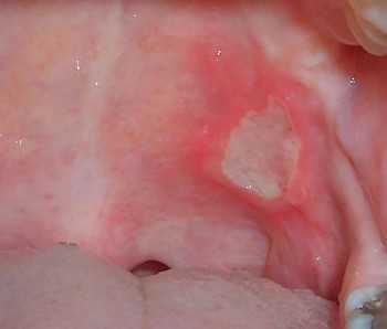 Crohn's mouth ulcers: What to know