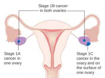 Weight loss surgery may prevent womb cancer