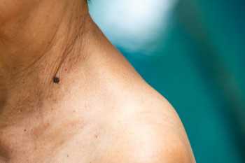 Melanoma: Keeping these molecules apart could stop cancer spread